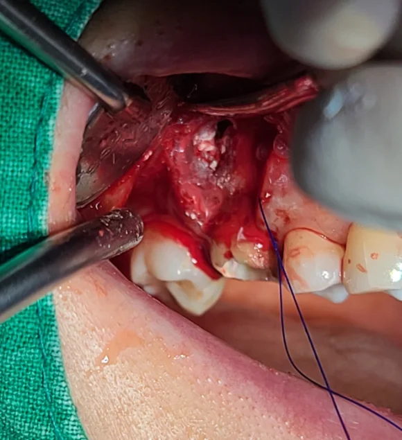 성신여대-치근단절제술-apicoectomy-뿌리끝-염증조직-제거-수술노출-성모치과의원