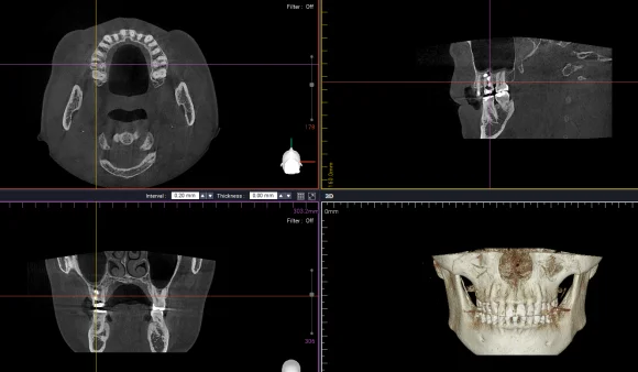 성신여대-치근단절제술-MTA-retrofilling-CBCT-뿌리끝-밀봉확인-성모치과의원