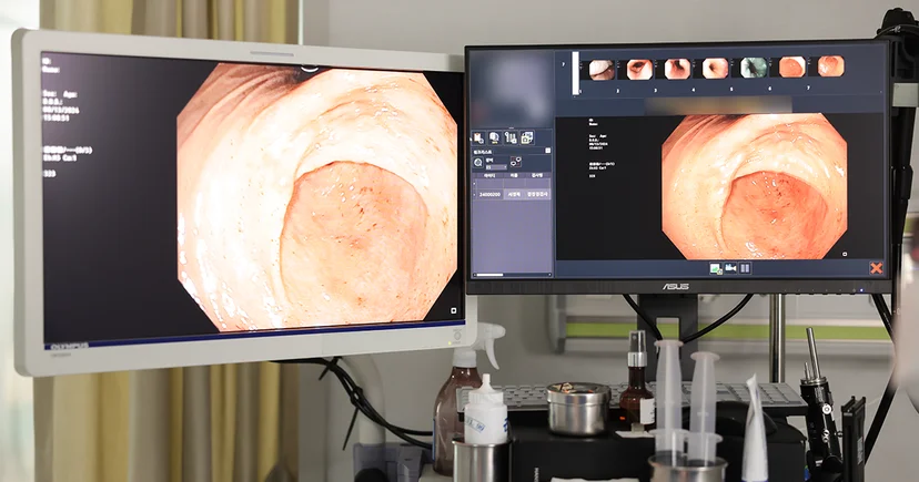 울산대장내시경 당일 용종 절제 더프라우병원 내시경센터 올림푸스 CLV-190 첨단 장비 활용 검사
