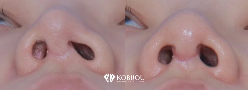 [코비쥬의원] 지지대가 틀어짐으로 인해 발생한 비공비대칭 변화를 비교한 사례 사진