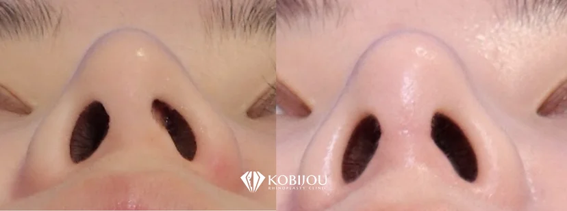 [코비쥬의원] 지지대가 틀어짐으로 인해 발생한 비공비대칭 변화를 비교한 사례 사진