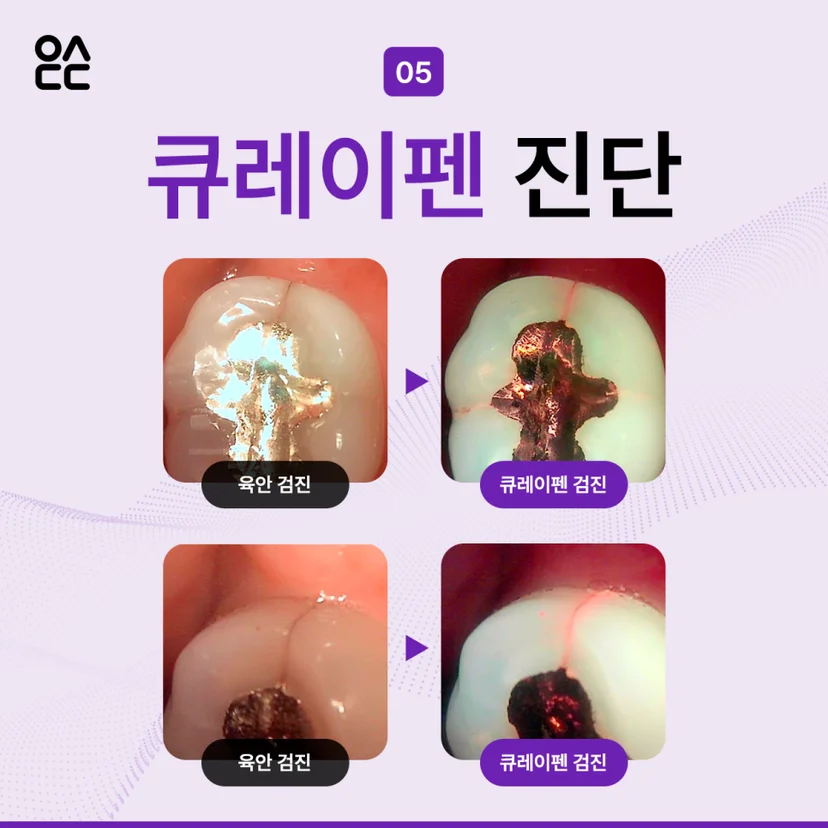 큐레이펜 진단 케이스