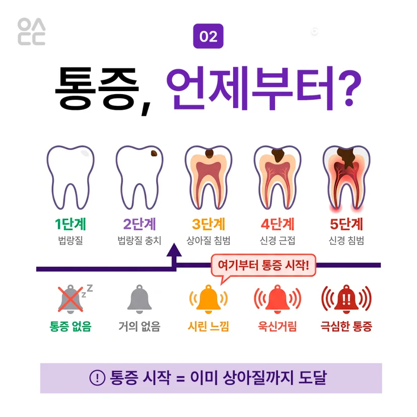 충치 통증은 언제부터?