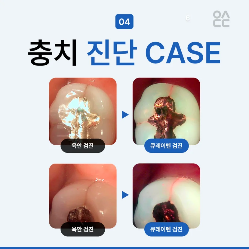 충치 진단 케이스