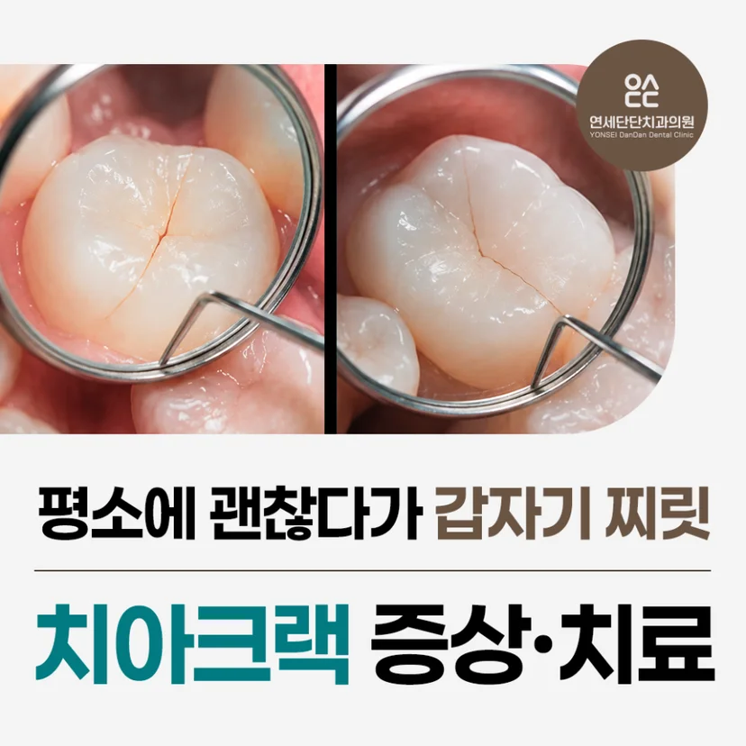 '치아 크랙' 표지