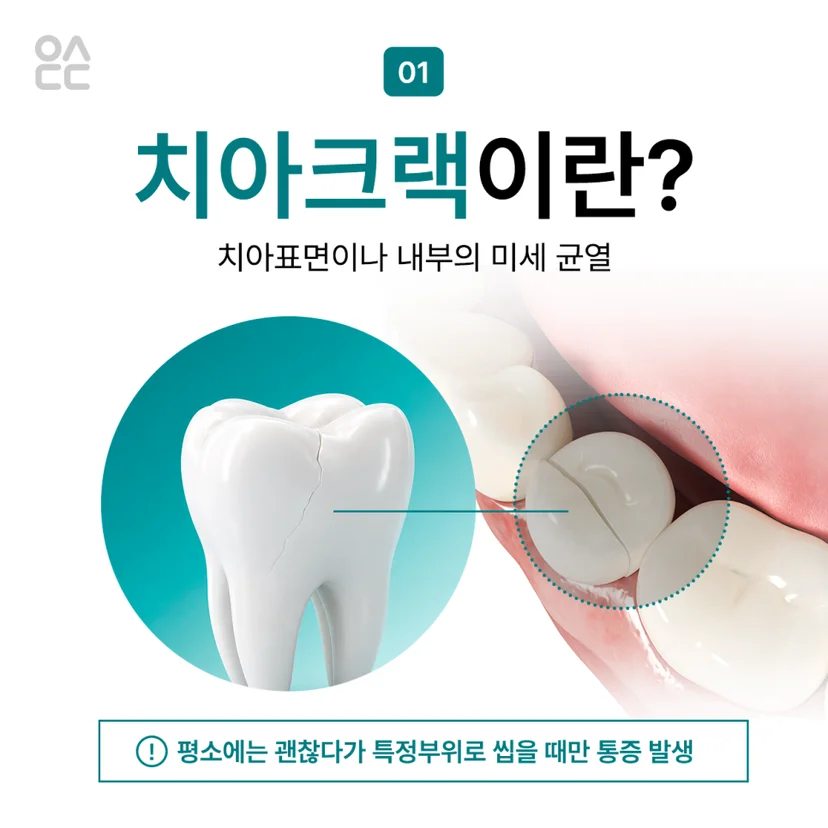 치아크랙 정의