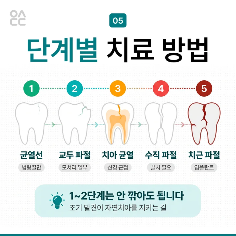 치아크랙 단계별 치료방법