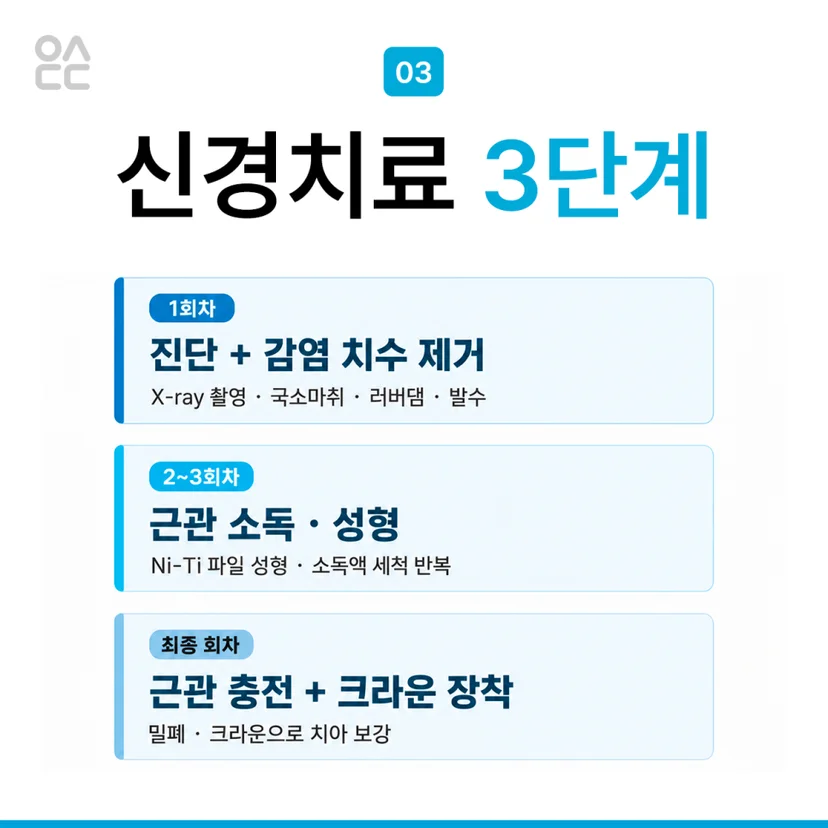 신경치료 단계