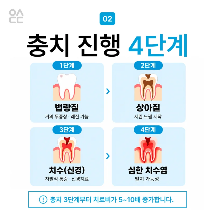 충치 진행 단계