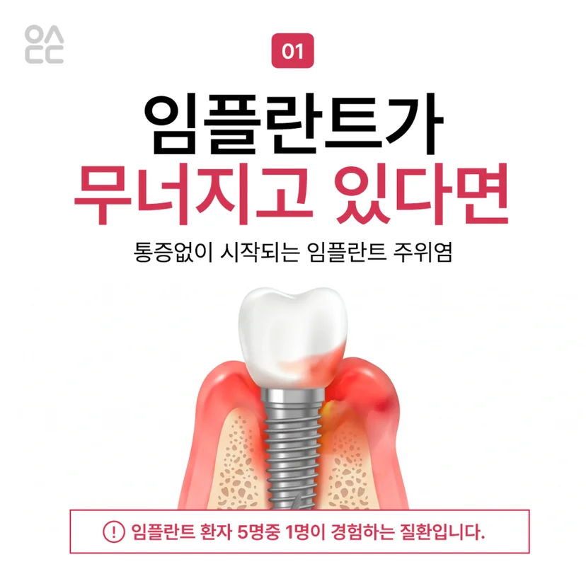 임플란트 주위염 설명