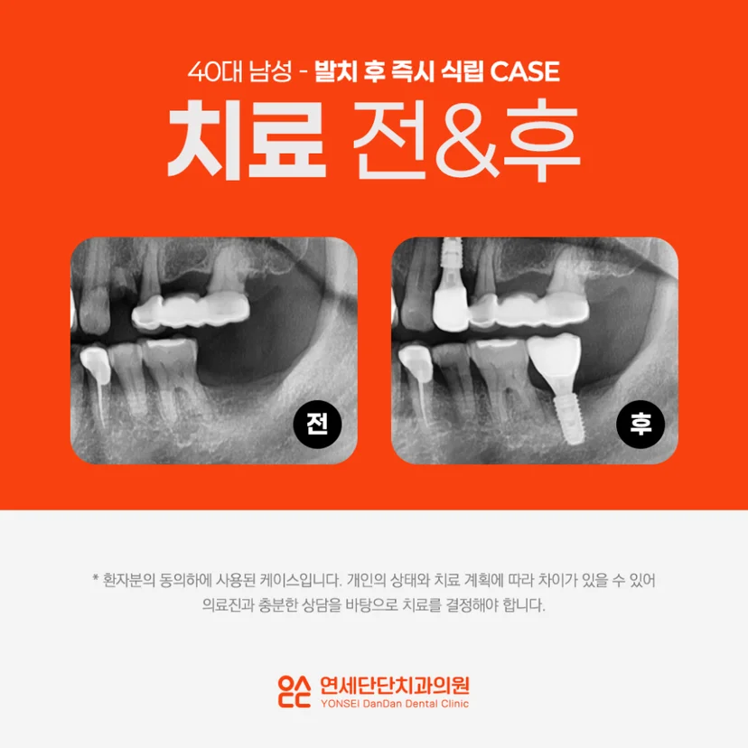 발치 후 즉시식립 임플란트