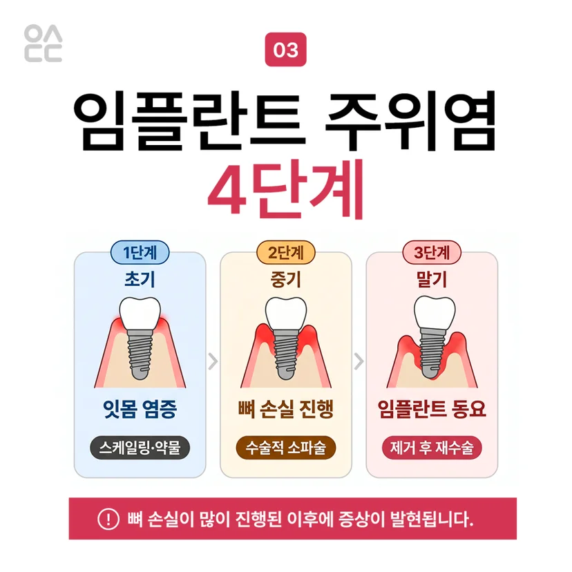 임플란트 주위염 단계