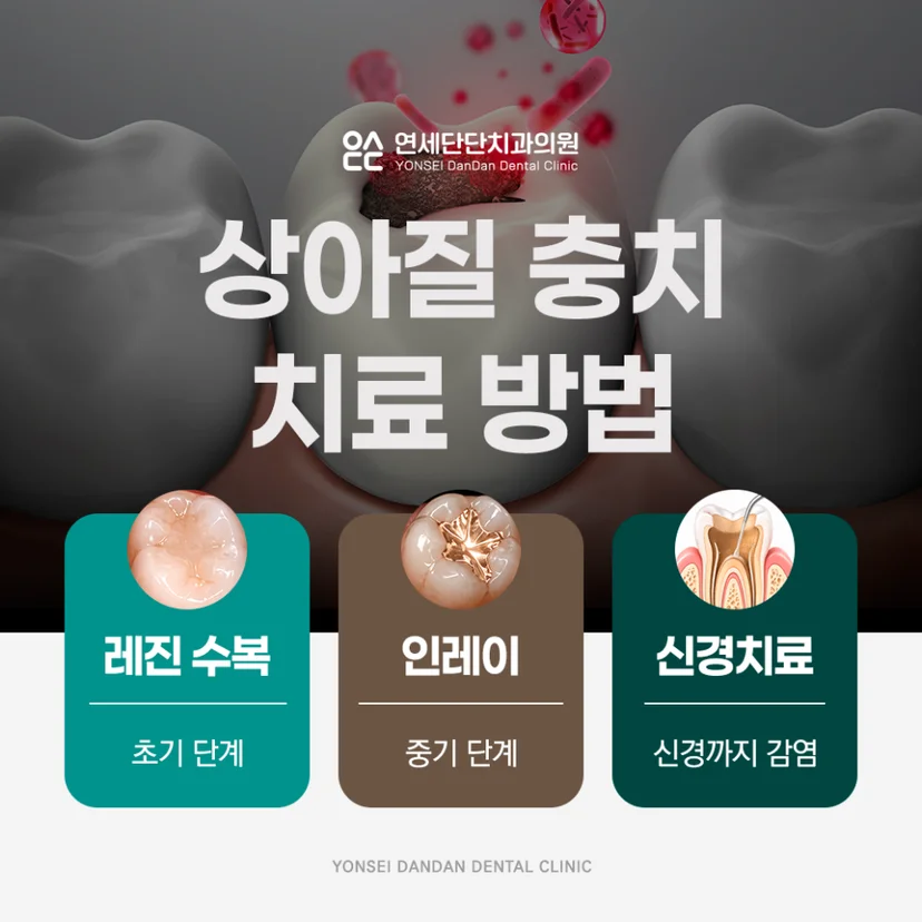 상아질 충치 치료 방법
