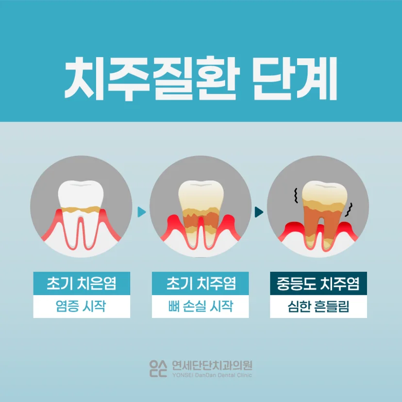 치주질환 단계