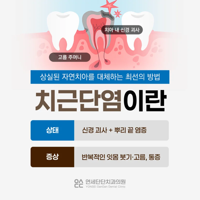 치근단낭염 설명