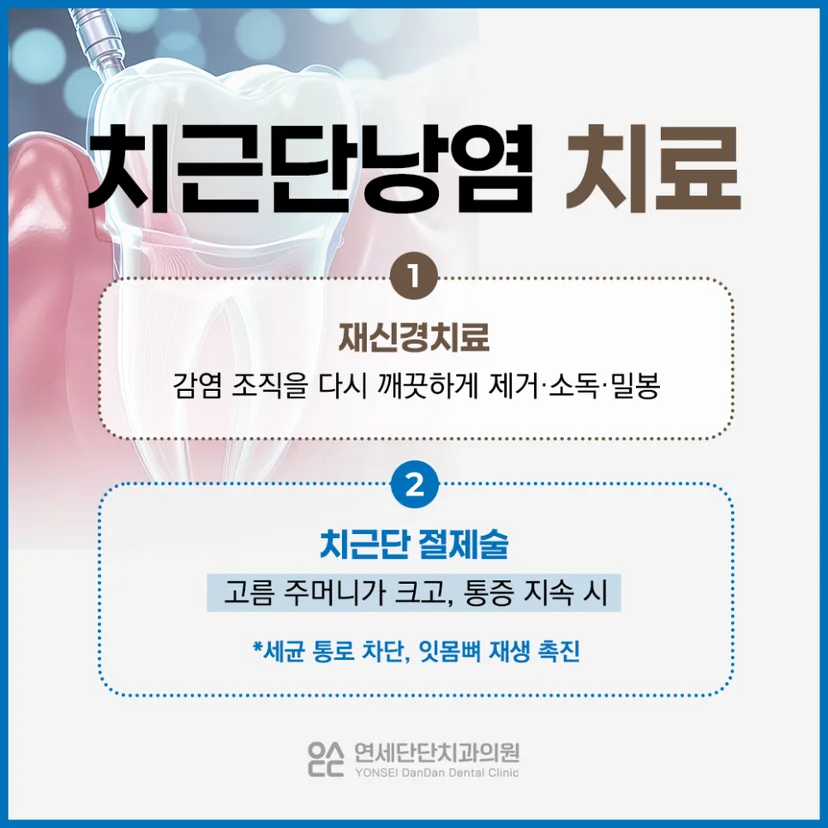 치근단낭염 치료