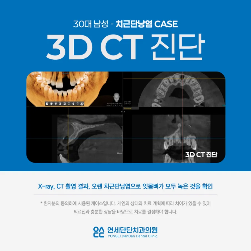 치근단낭염 진단
