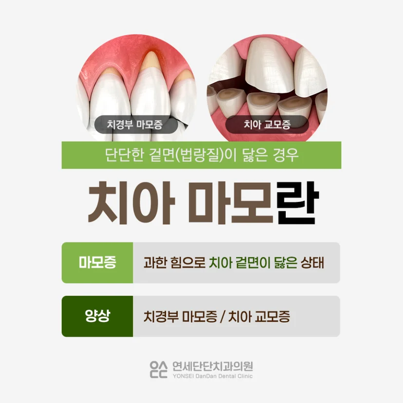치아 마모 설명