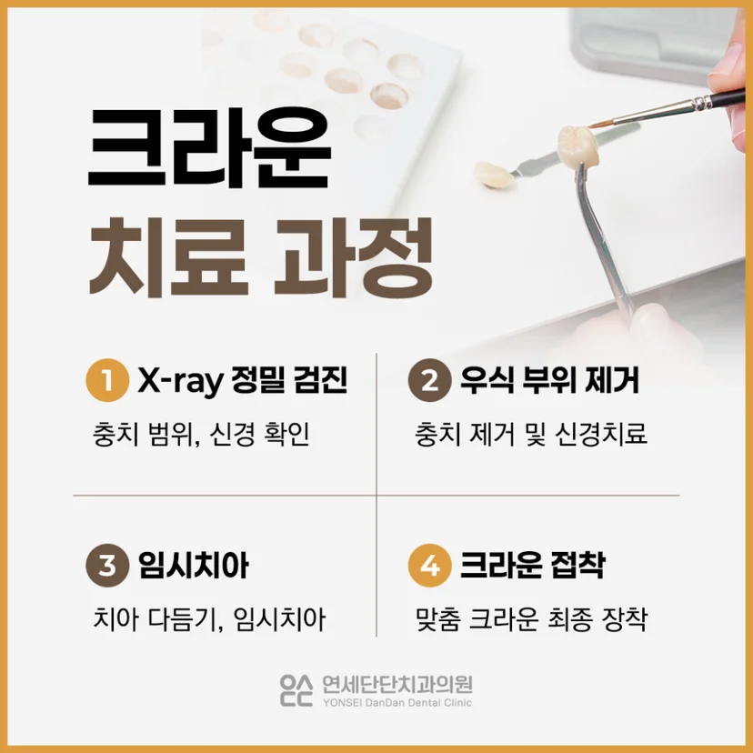 크라운 치료 과정
