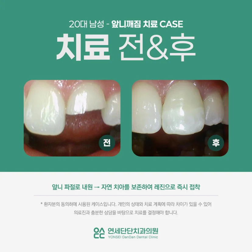 앞니깨짐 치료전후 케이스