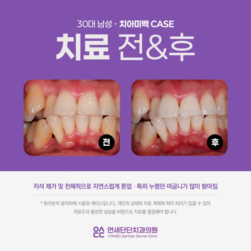 미백 전후