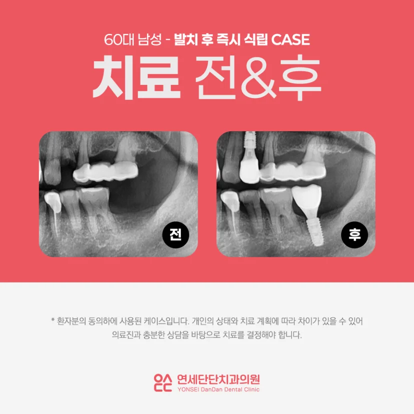 발치 후 즉시 식립 임플란트
