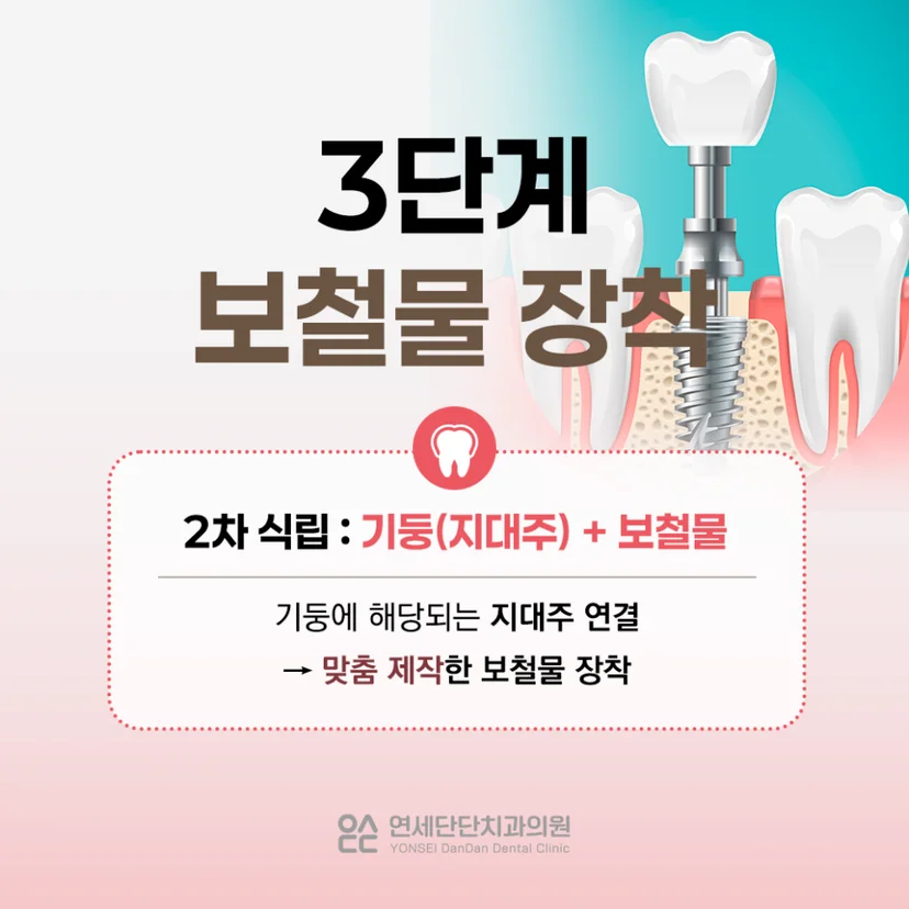 임플란트 단계
