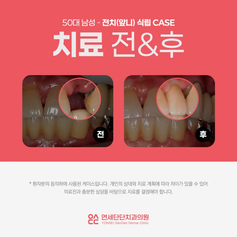 앞니 임플란트