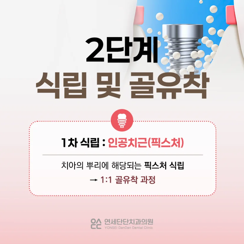 임플란트 단계
