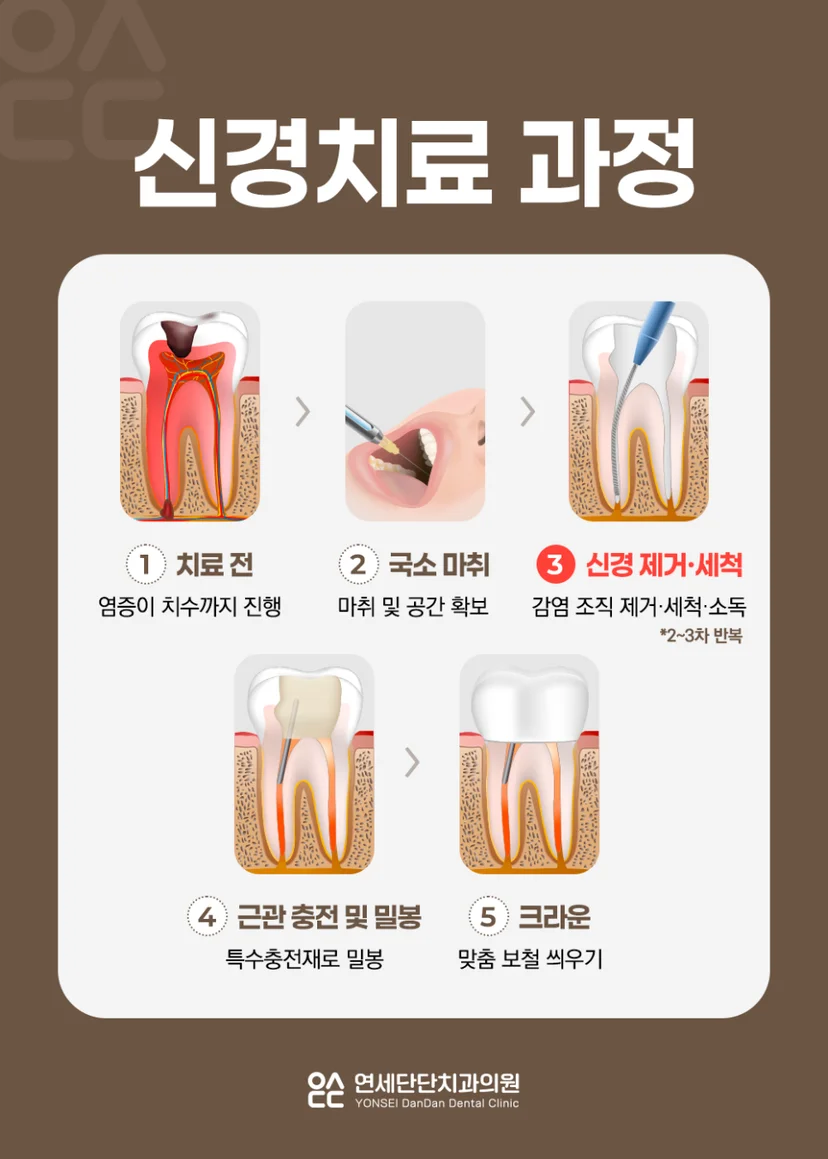 신경치료 과정