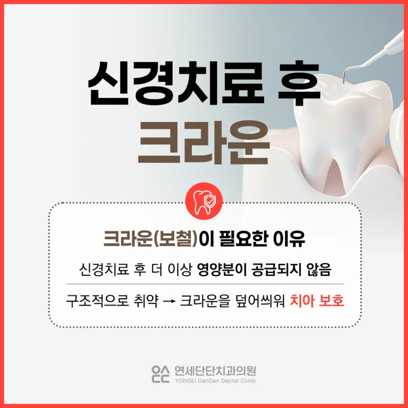 신경치료 후 크라운