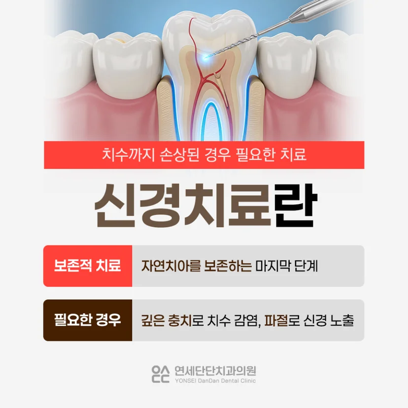 신경치료 설명