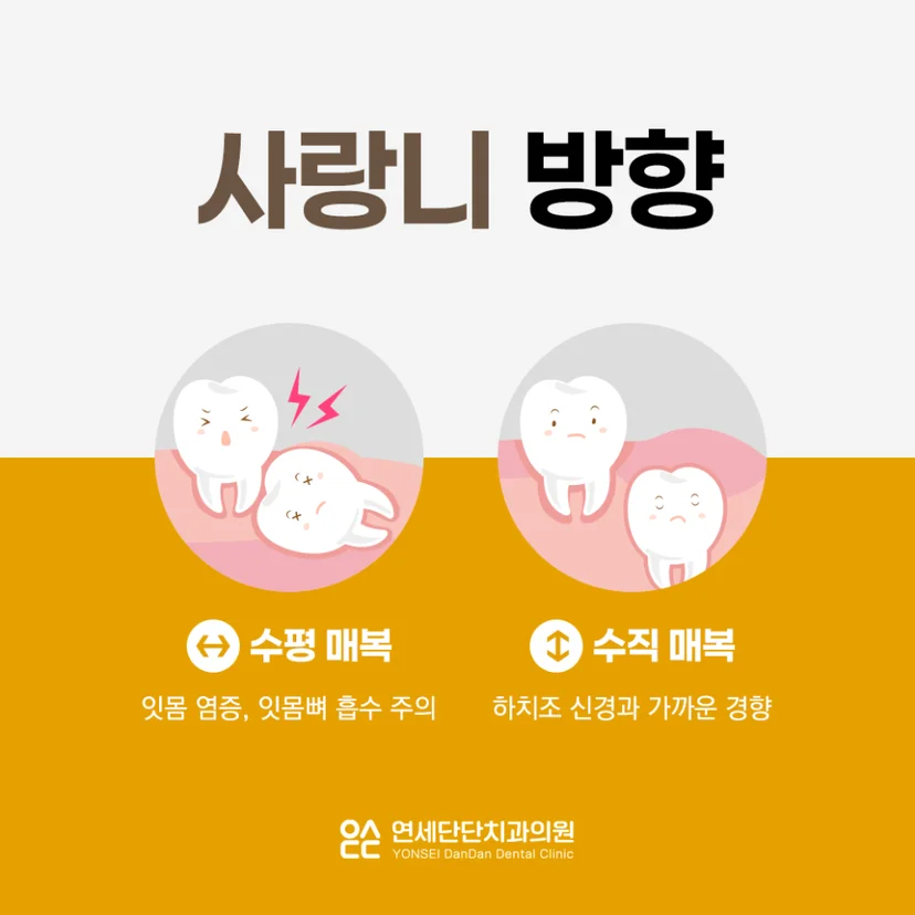 완전매복 사랑니 방향
