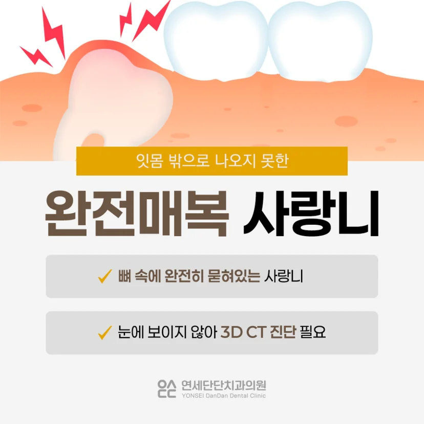 완전매복 사랑니 설명