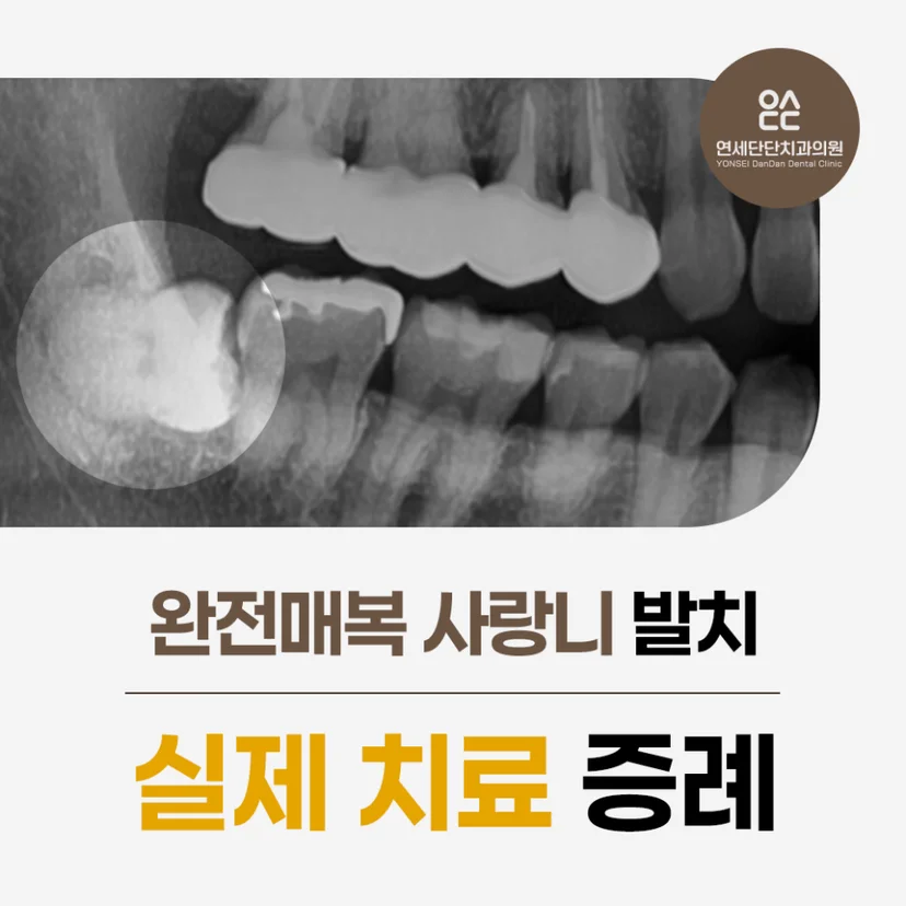 완전매복 사랑니 표지