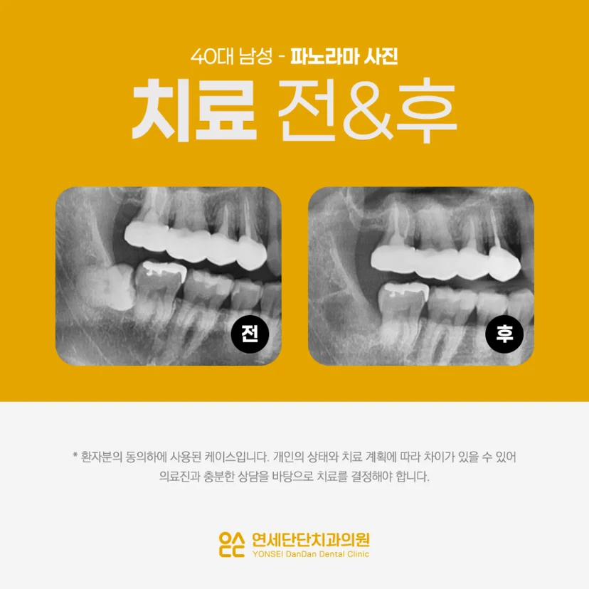 완전매복 사랑니 치료