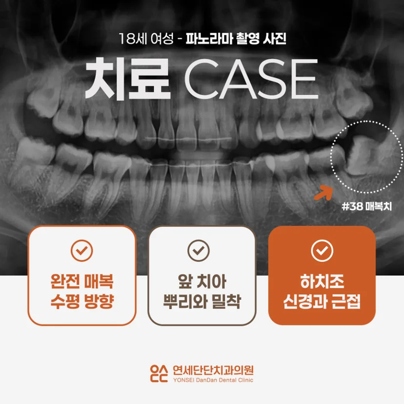 누워있는 사랑니 발치 사례