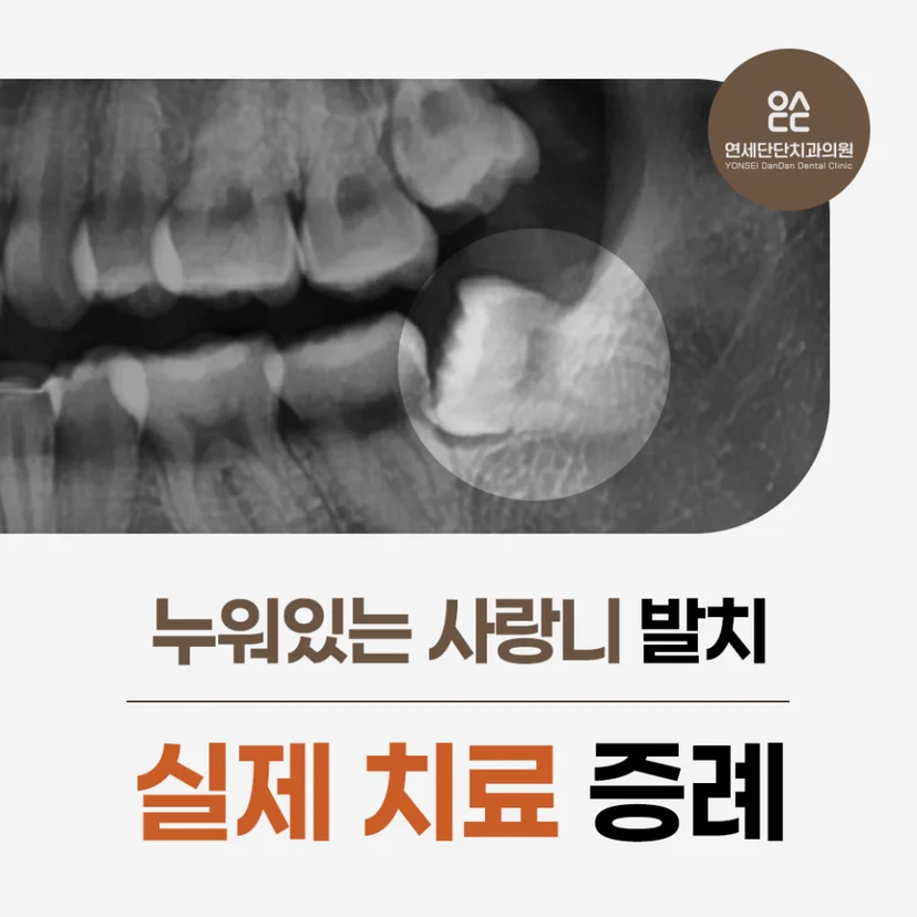 누워있는 사랑니 표지