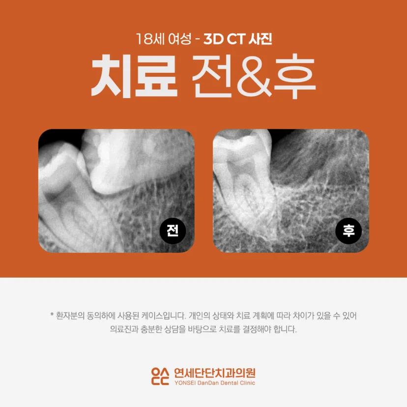 누워있는 사랑니 발치 사례