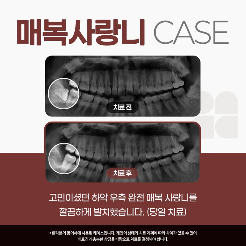 매복 사랑니 발치 사례