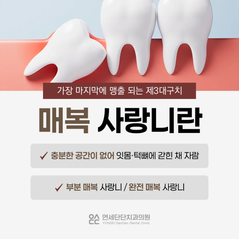 매복 사랑니 설명