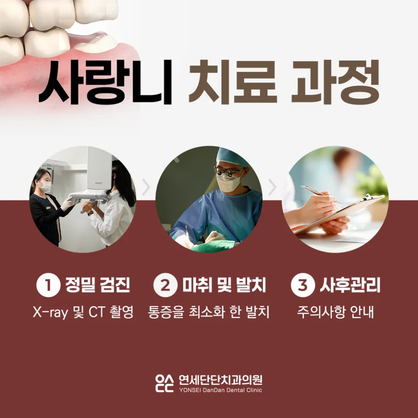 매복 사랑니 발치 과정