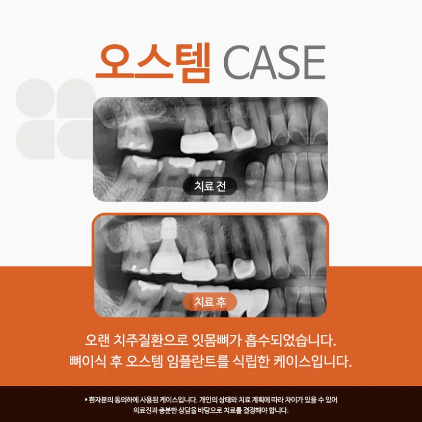 오스템 임플란트 사례