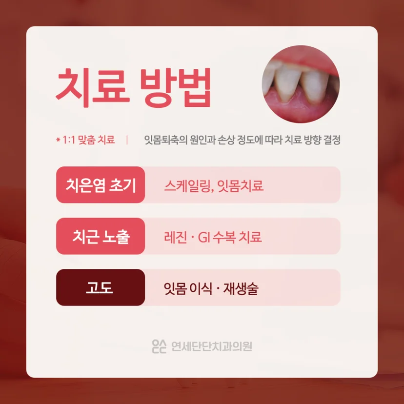 잇몸 내려앉음 치료