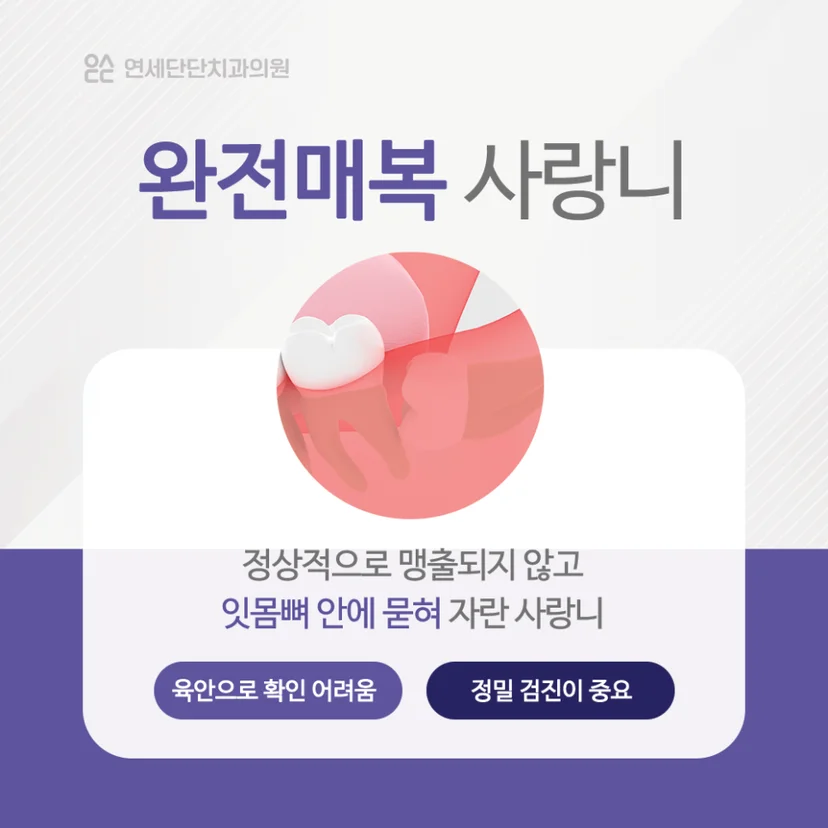 완전매복 사랑니 설명