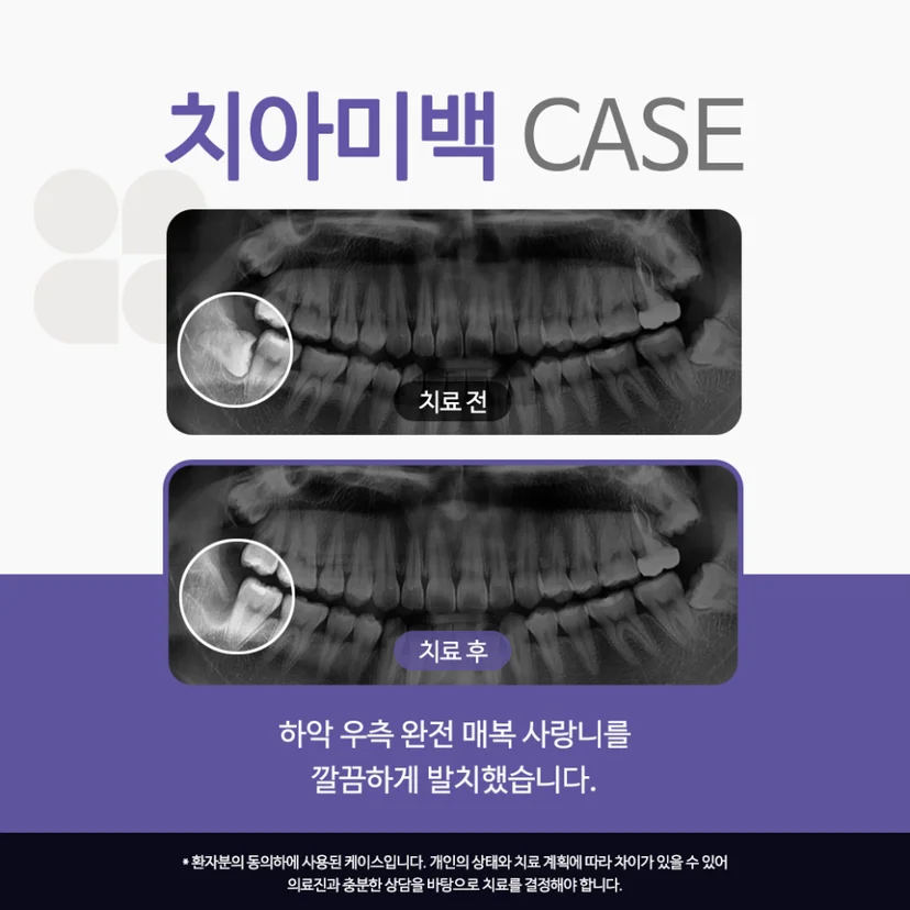 완전매복 사랑니 발치 사례