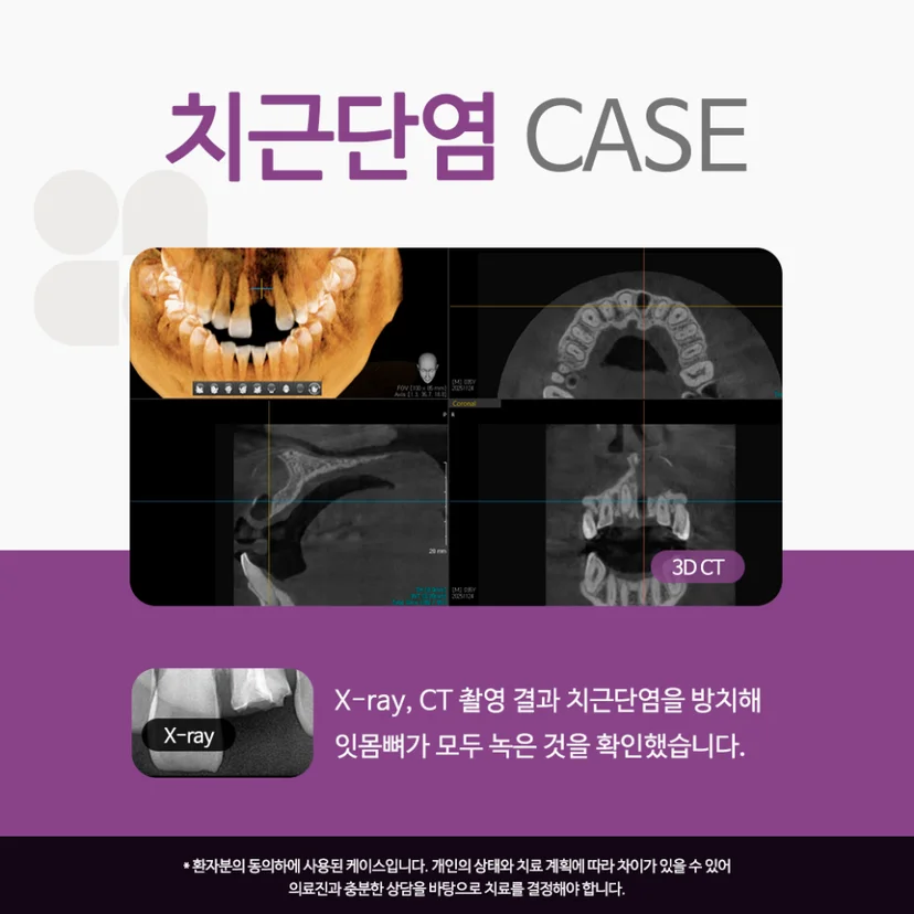 치근단염 사례