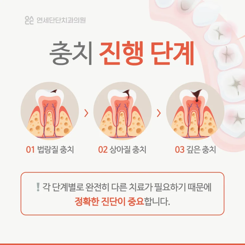 충치 진행 단계