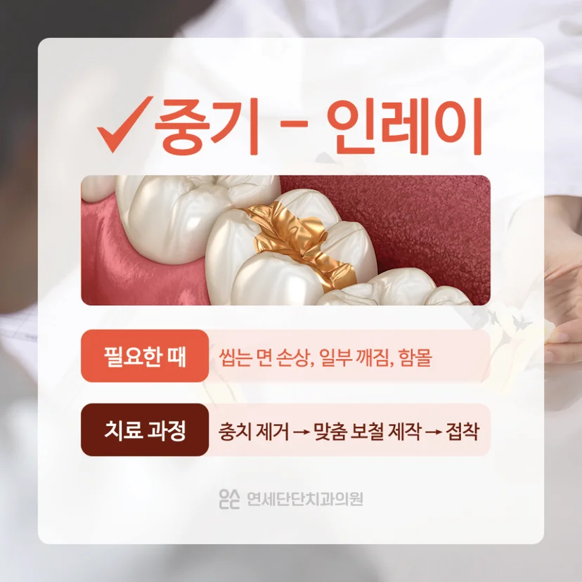충치치료 인레이