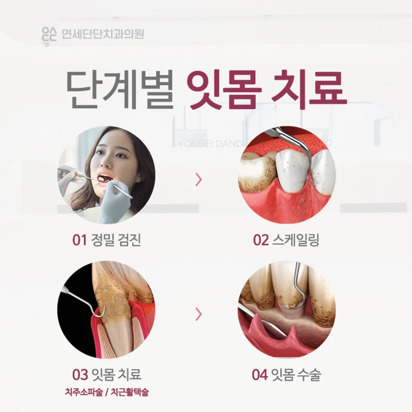 단계별 잇몸 치료